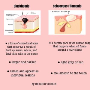 Difference betweetn sebaceous filaments & blackheads