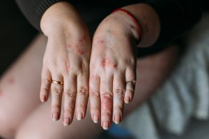 hand eczema 