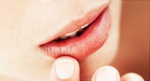 Canker Sores on lips