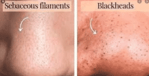 difference of blackheads and sebaceous filaments