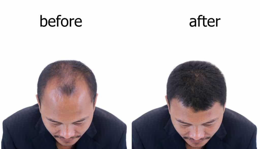 Hair Replacement before and after