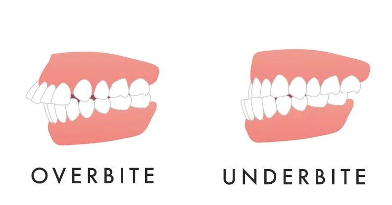 An Underbite or Overbite