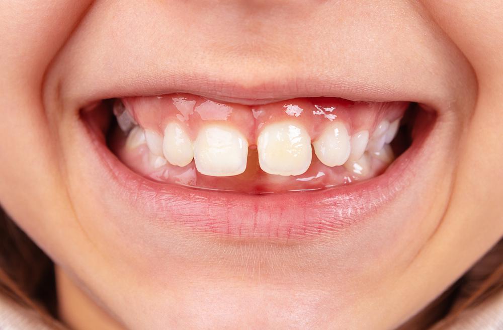teeth gaps and alignmen issue