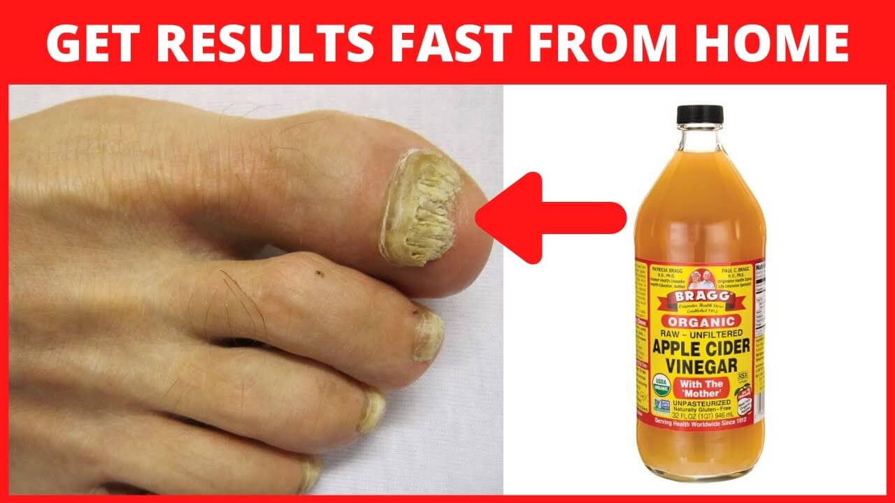 How To Use Hydrogen Peroxide For Nail Fungus Removal? | Its Charming Time