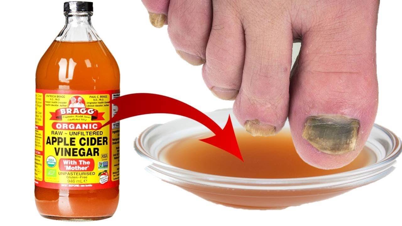 How To Use Apple Cider Vinegar For Toenail Fungus? - Its Charming Time