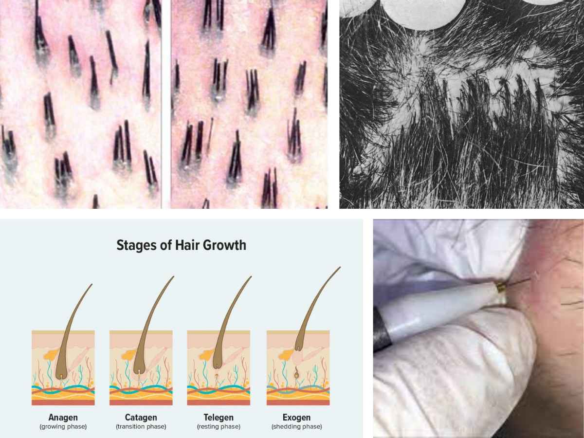 can-multiple-hairs-grow-from-one-follicle-its-charming-time