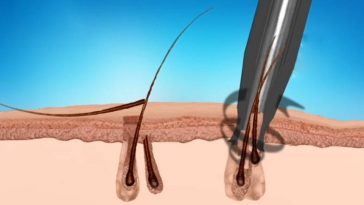 Pili Multigemini Disorder - Causes and Treatment of Multiple Hairs in One  Follicle | Its Charming Time