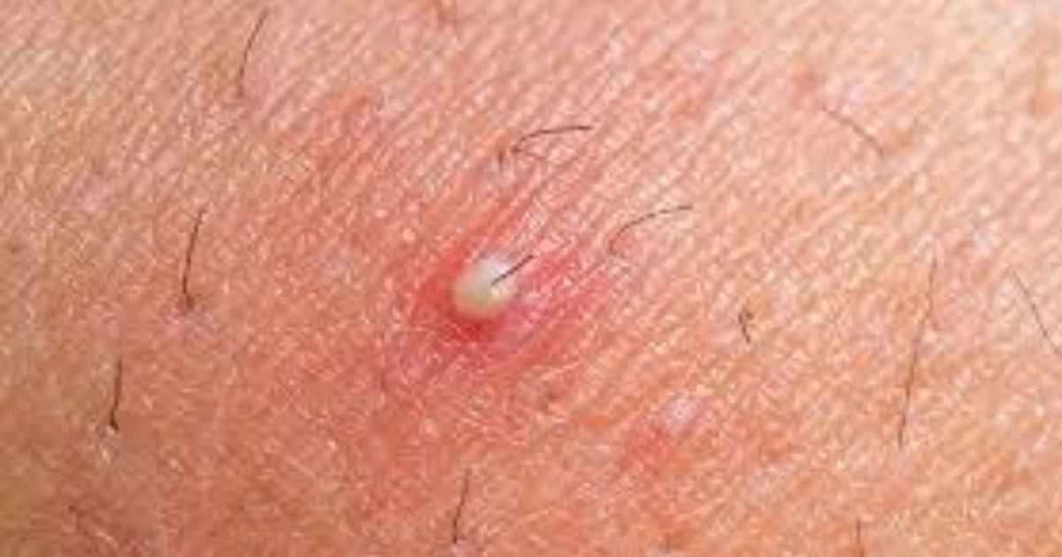 vaginal ingrown hair