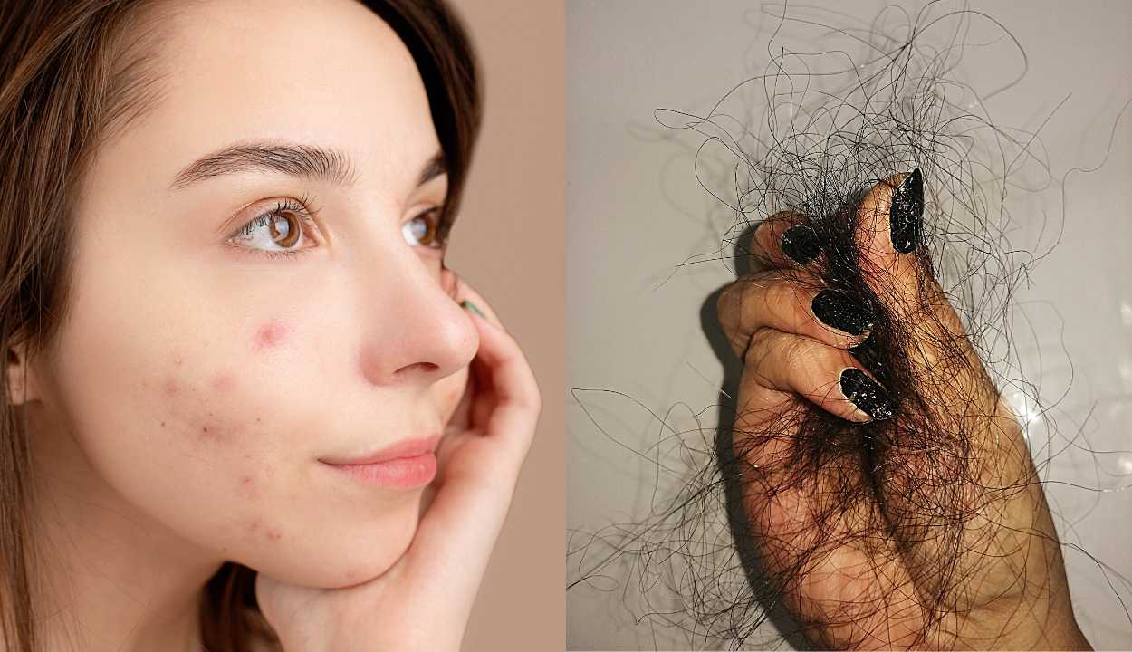 a girl having facial acne and hair loss