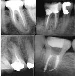 X-ray of the Tooth