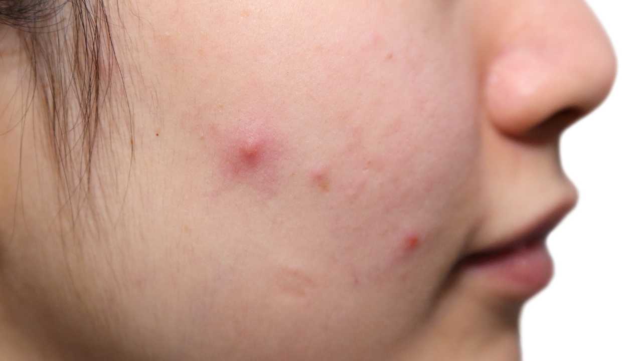 a girl having face acne