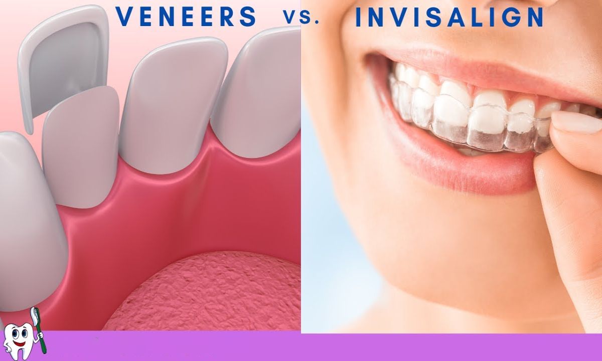 Which is Better Invisalign or Veneer