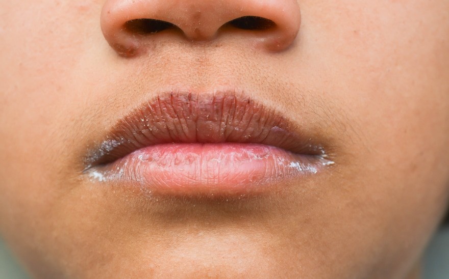 Nutritional Deficient Lips