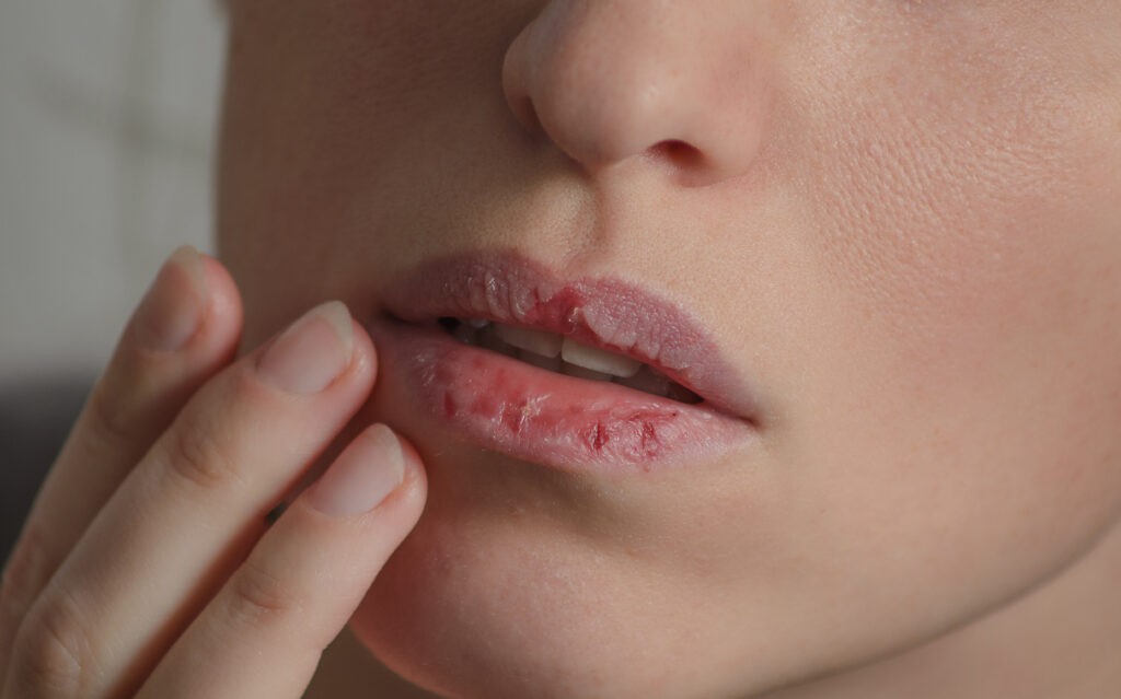 Signs and Symptoms of Cracked Lips