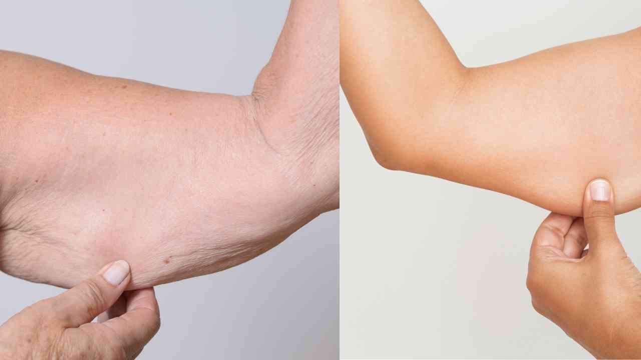 a woman with loose skin on her arm and a woman with tight skin on her arm