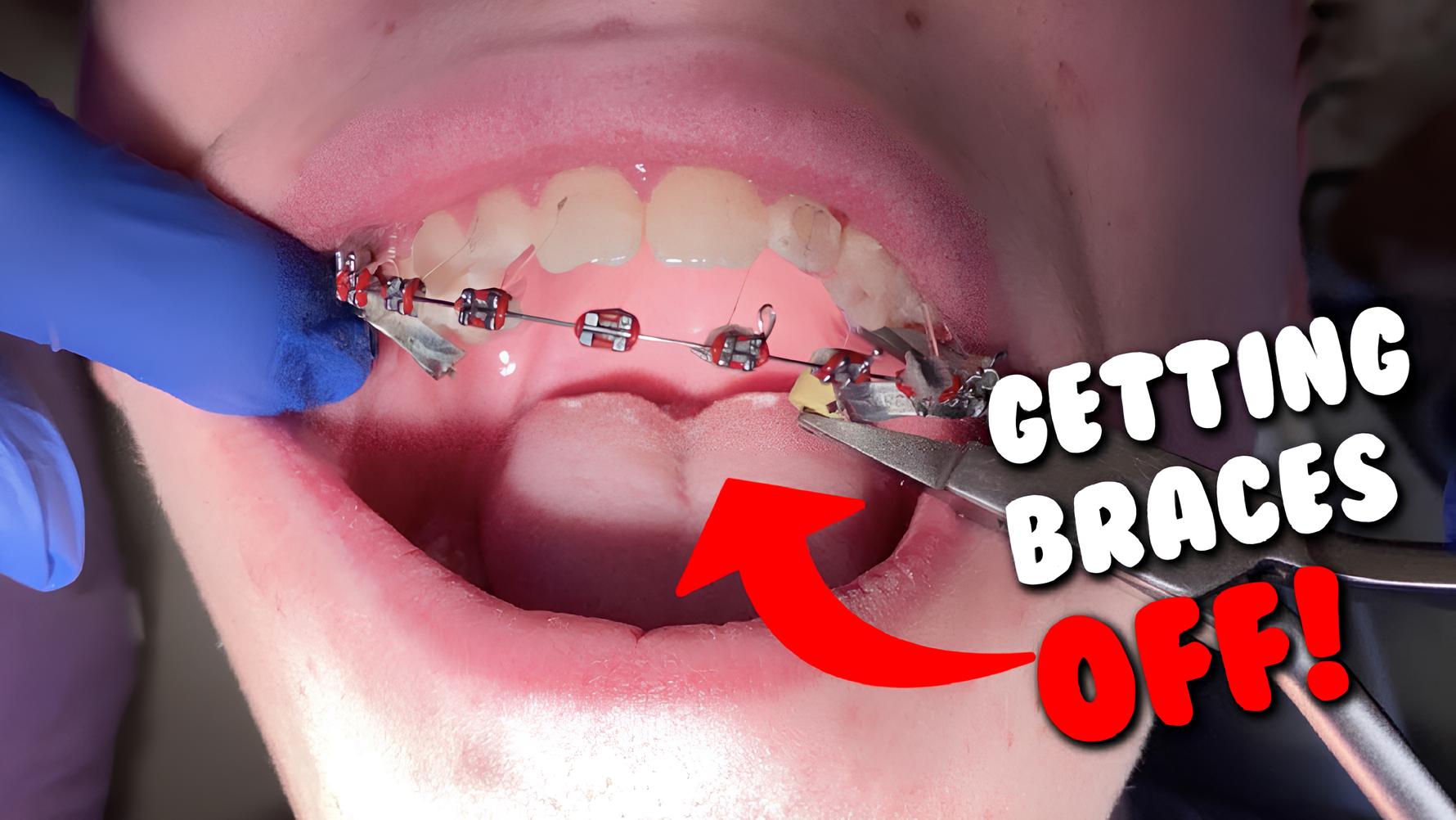 braces-removal-guide-procedure-pain-and-post-care-tips-for-a-perfect