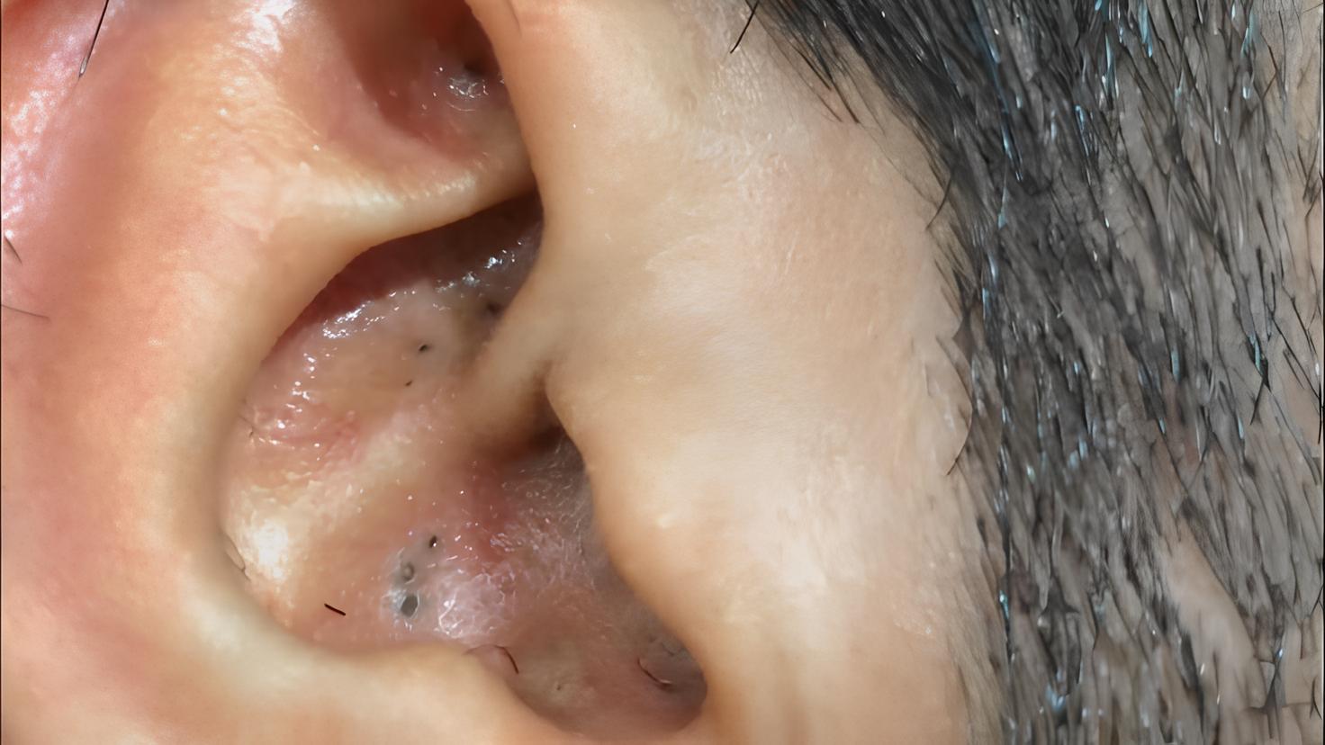 Reason for Blackheads Formation Inside the Ear
