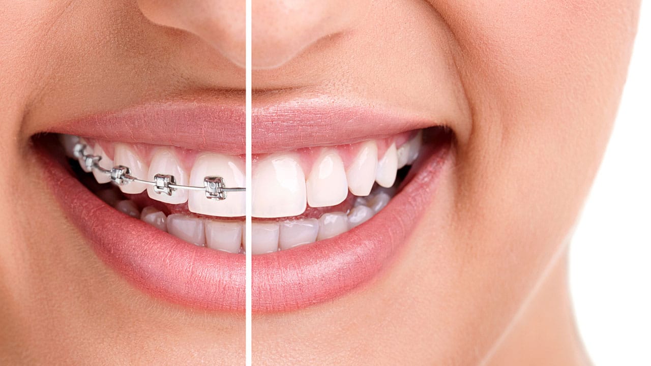 What to Expect after the Braces are Removed