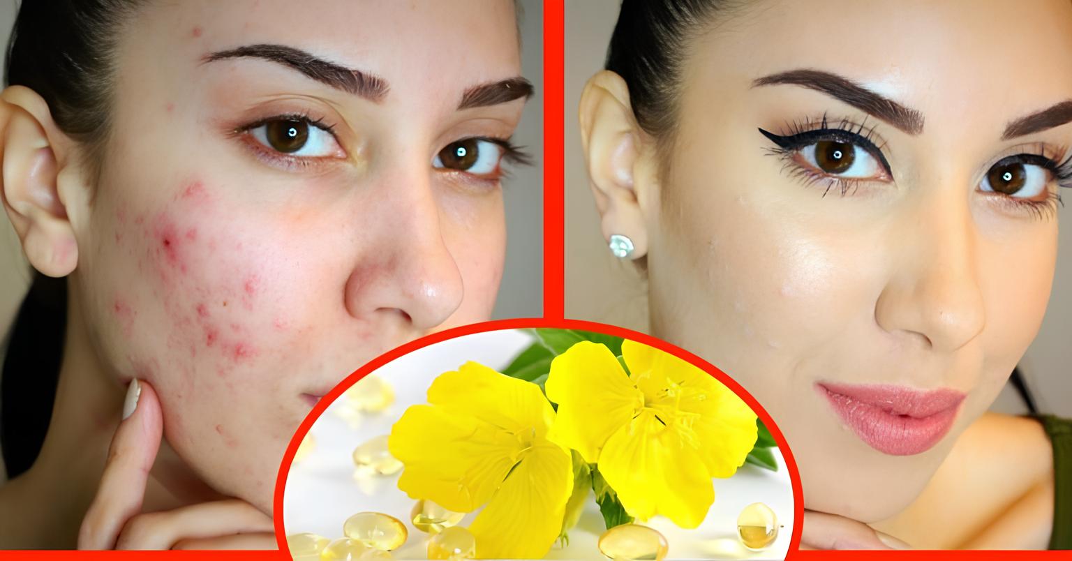 Effects of Evening Primrose Oil on Skin