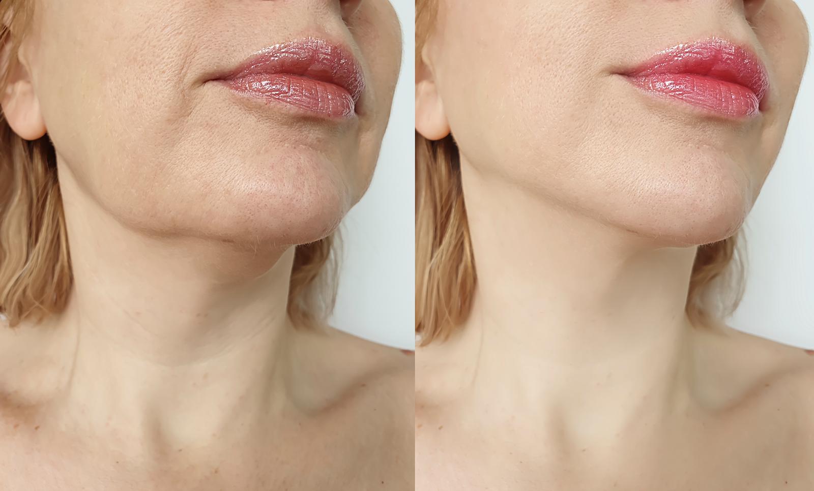 Expect after a Jawline Filler Treatment
