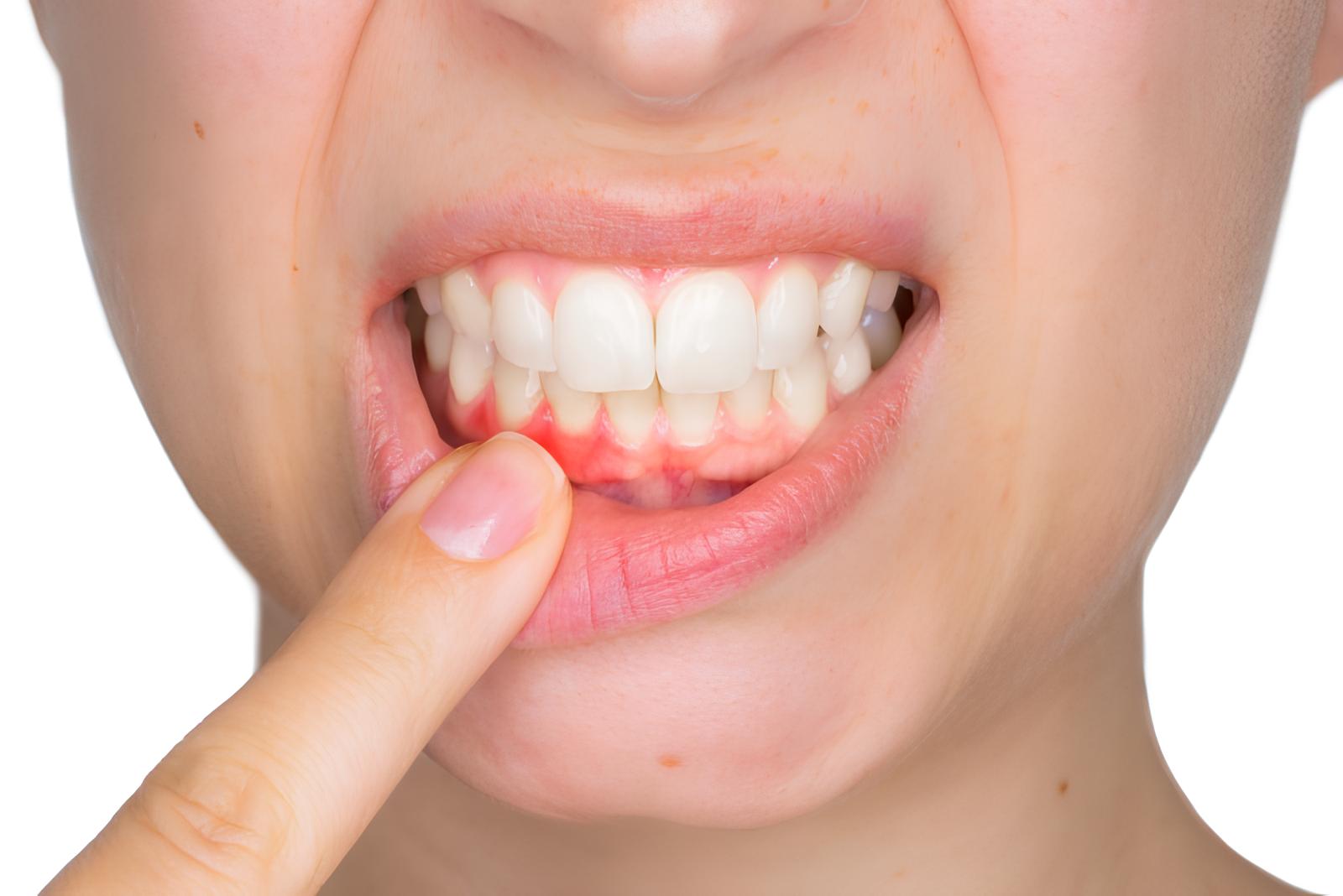 Signs of Developing Gum Diseases